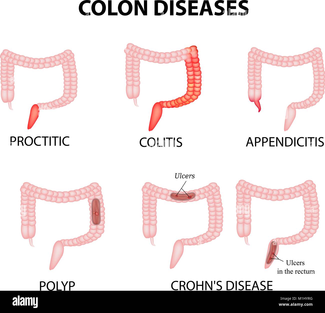 Colon diseases. Proctitis, colitis, appendicitis, polyp, ulcer Stock ...