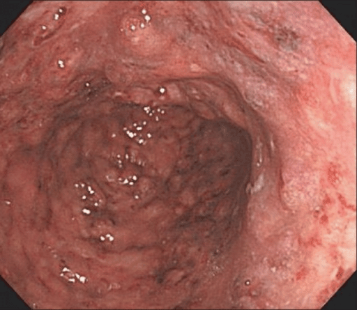Colonoscopic finding. Colonoscopy shows diffuse ulcers