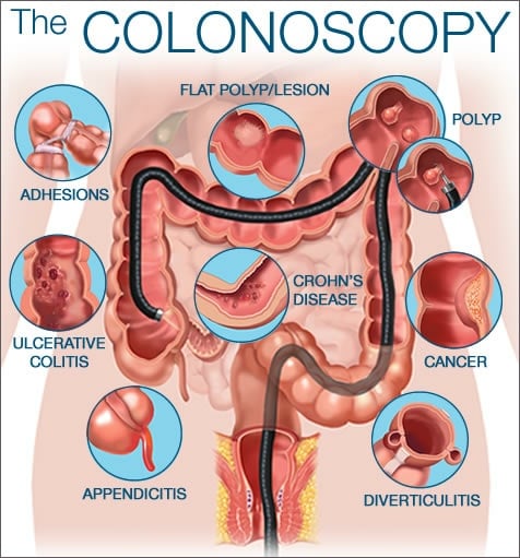 Colonoscopy for bowel problems