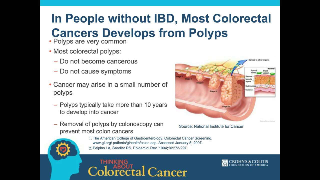 Colorectal cancer ibd inflammatory bowel disease ...