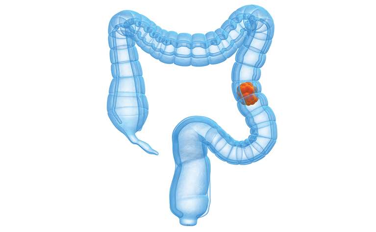Complications of ulcerative colitis