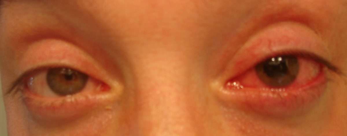 corneal ulcer