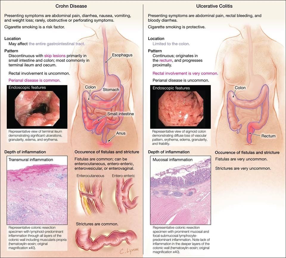 Crohnâs disease vs Ulcerative Colitis