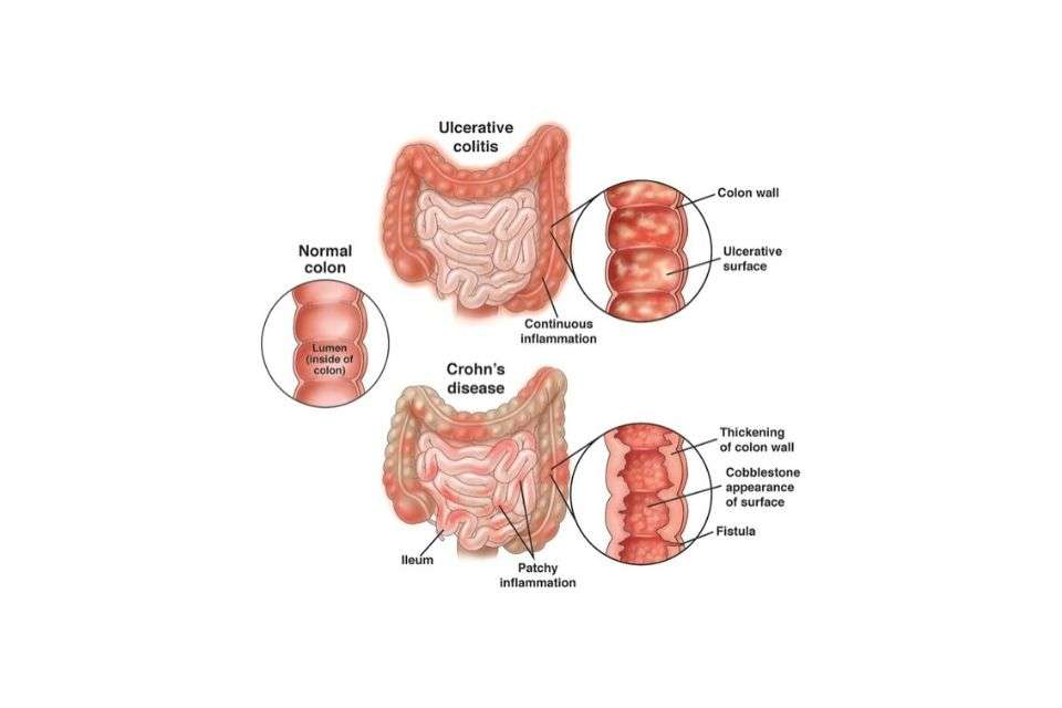 Crohns Disease and Ulcerative Colitis Awareness
