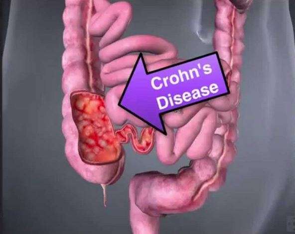 Crohn