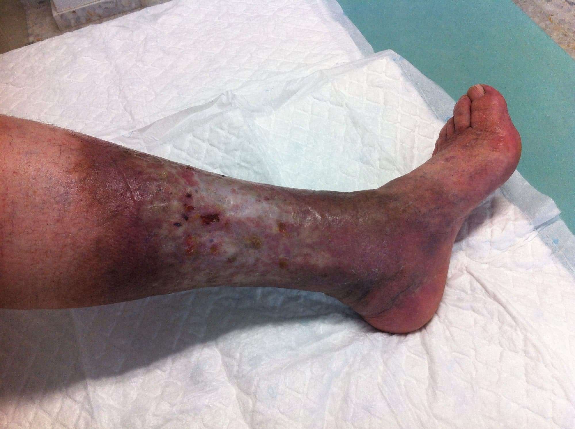 Current Treatment For Leg Ulcers