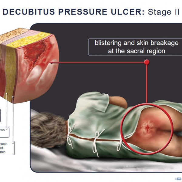 Decubitus Pressure Ulcer: Stage II