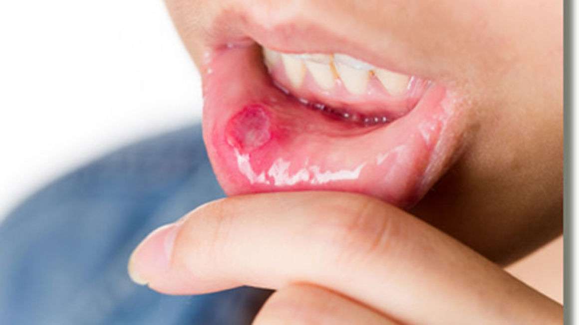 Dental clinic: Are mouth ulcers sign of having disease ...