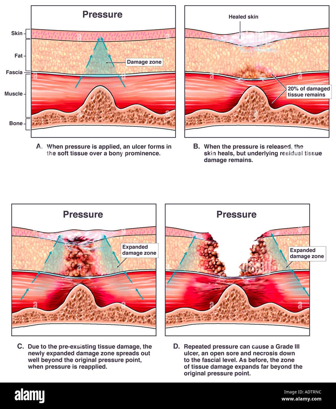 Development of Pressure Ulcers Stock Photo: 7710107