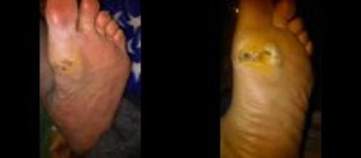 Diabetes &  diabetic foot ulcers (14)  Dr Wheatgrass