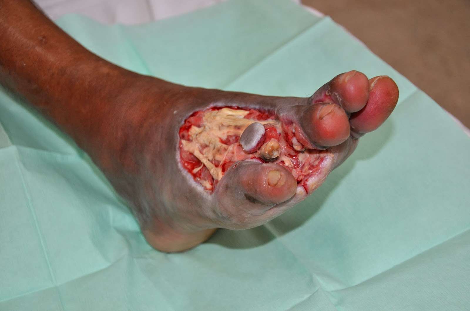 Diabetes Terengganu: Diabetic Foot Ulcer