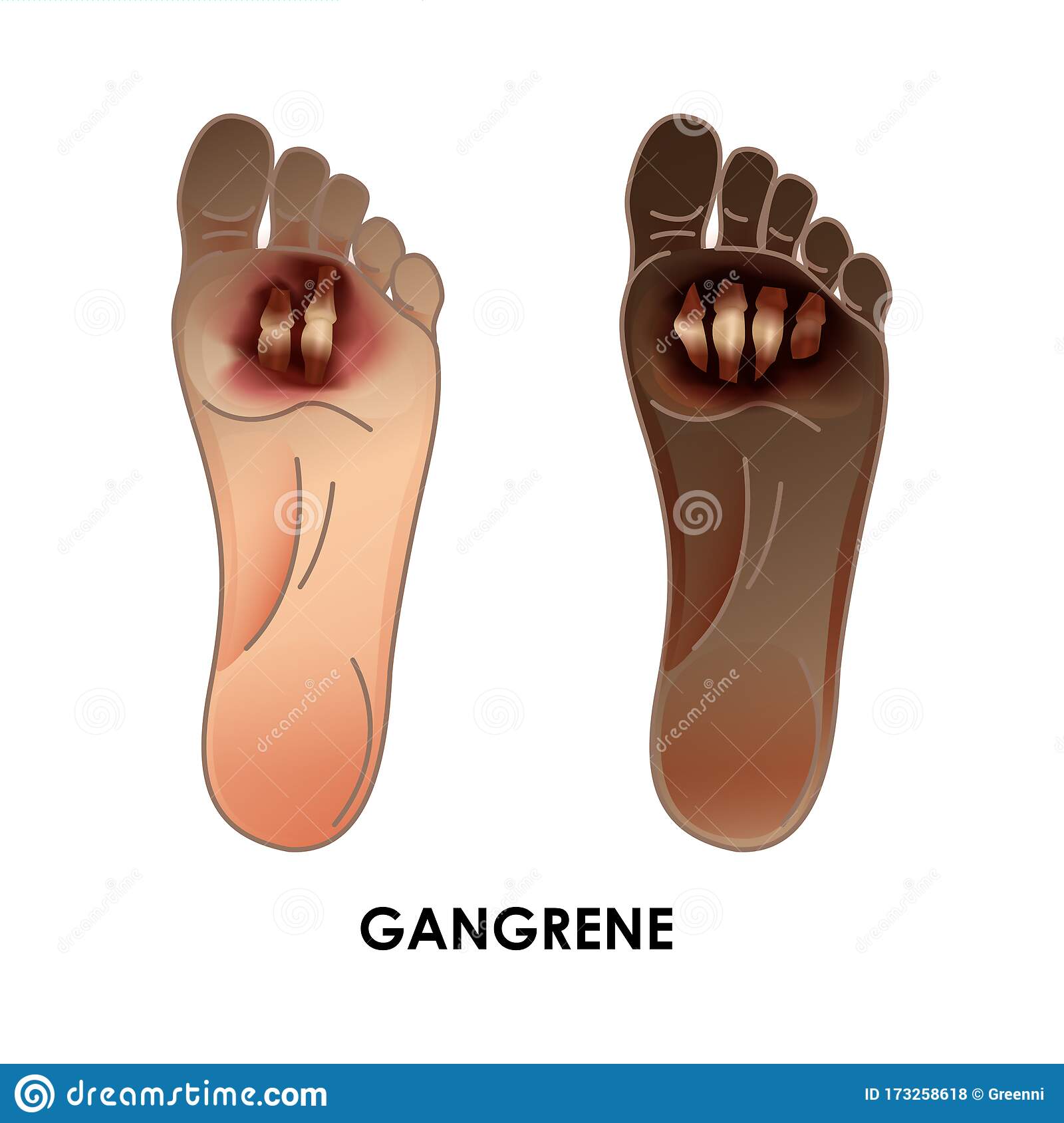 Diabetic Foot. Gangrene. Ulcers, Skin Sores on Foot Stock Illustration ...
