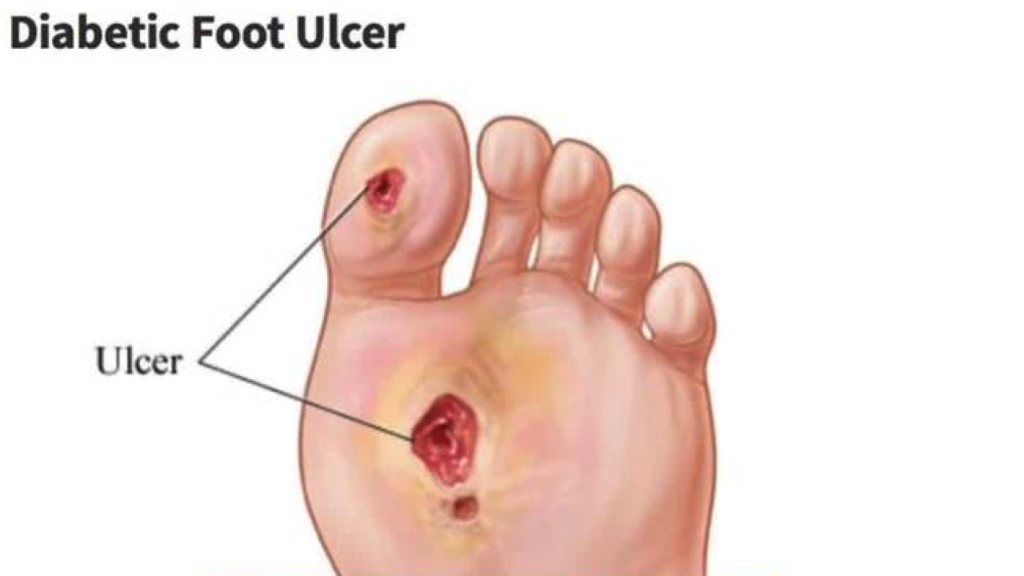 Diabetic Foot Ulcer and Foot Sores Treatment in Lubbock TX