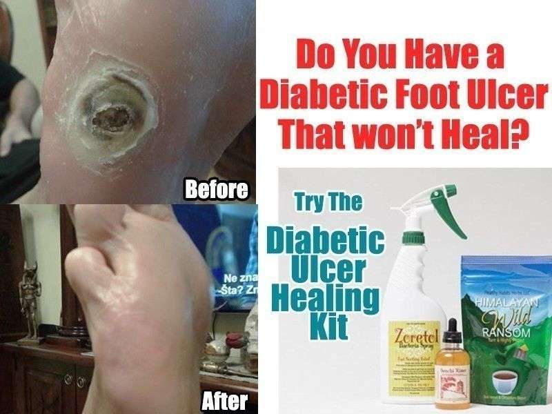 Diabetic Foot Ulcer or Gangrene Healing Kit