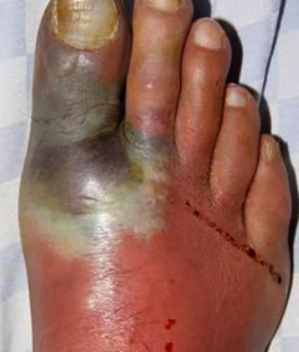 Diabetic Foot Ulcer With Gangrene Icd 10