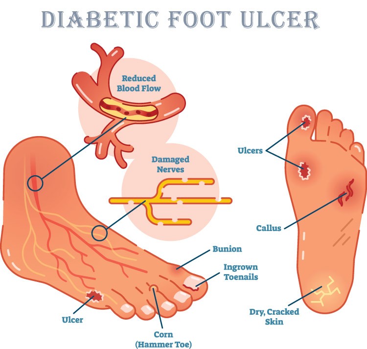 Diabetic Ulcers and Sores: Know Causes, Treatment and Prevention ...