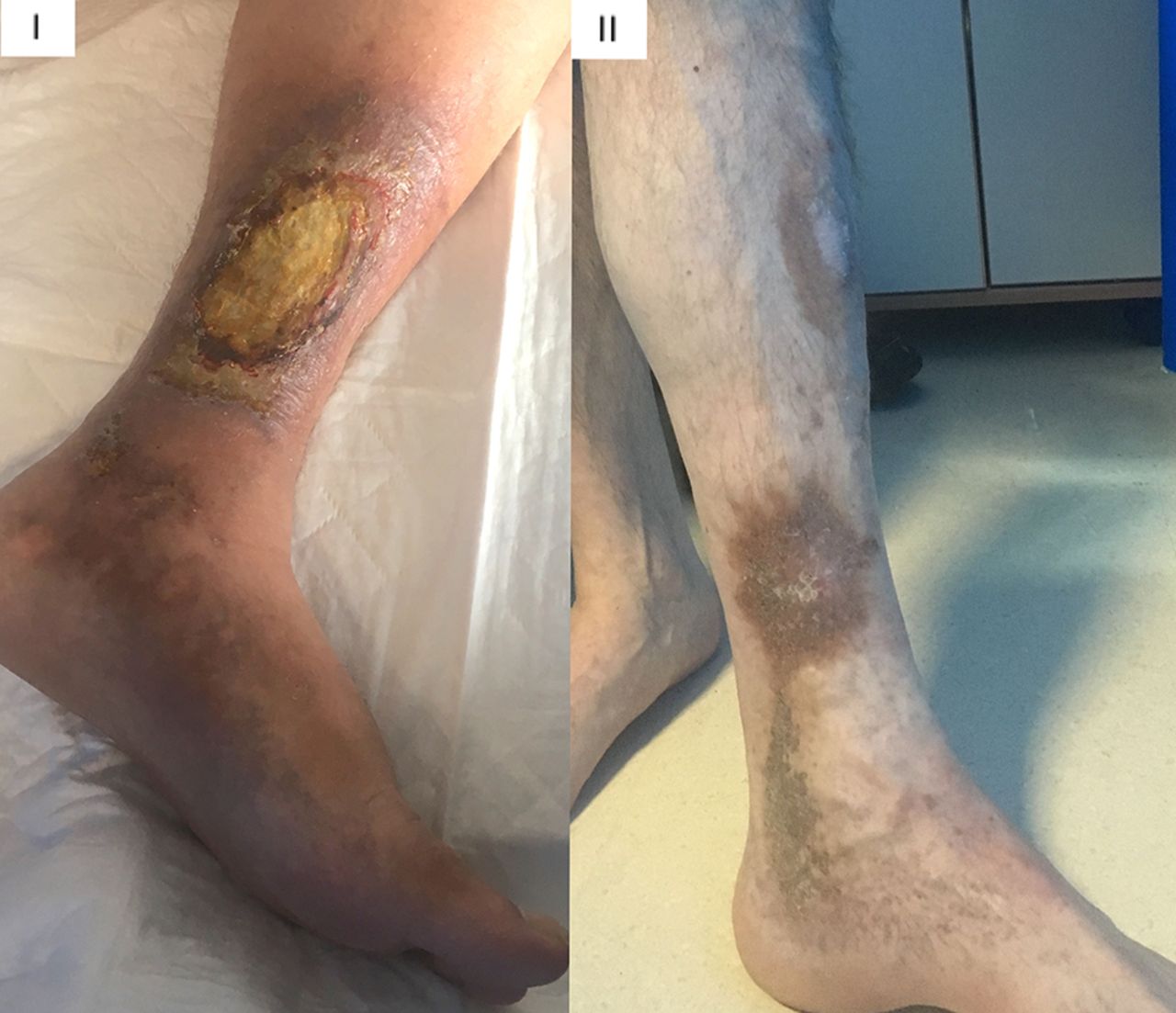 Diagnosis and management of venous leg ulcers