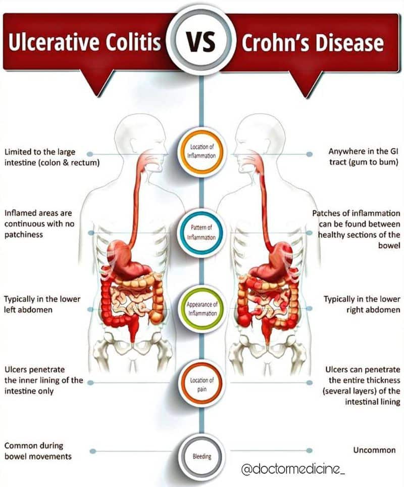 Difference between Ulcerative Colitis and Crohn