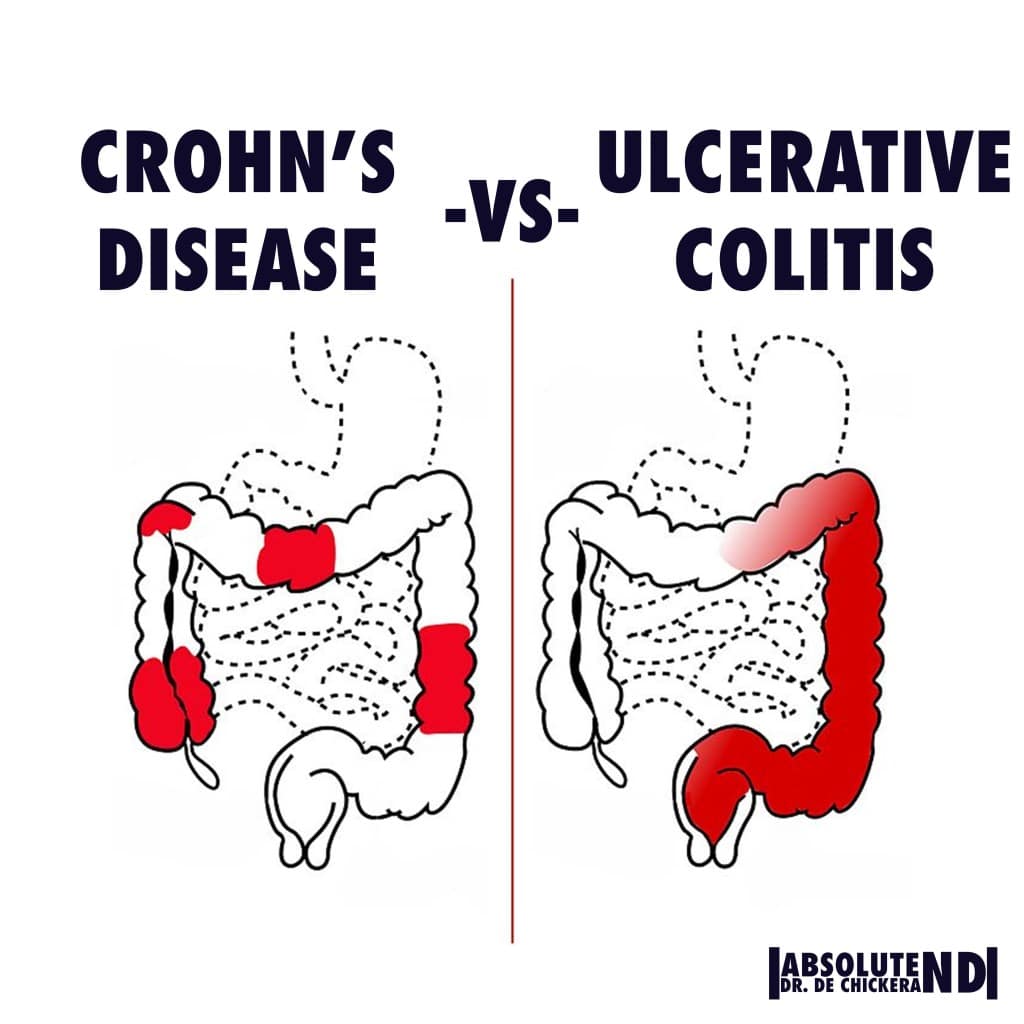 Differentiating Crohn