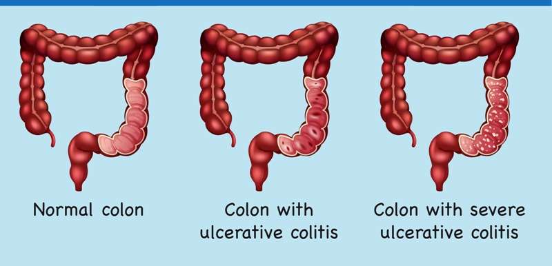 Disease Graphics, Videos &  Images on Ulcerative Colitis