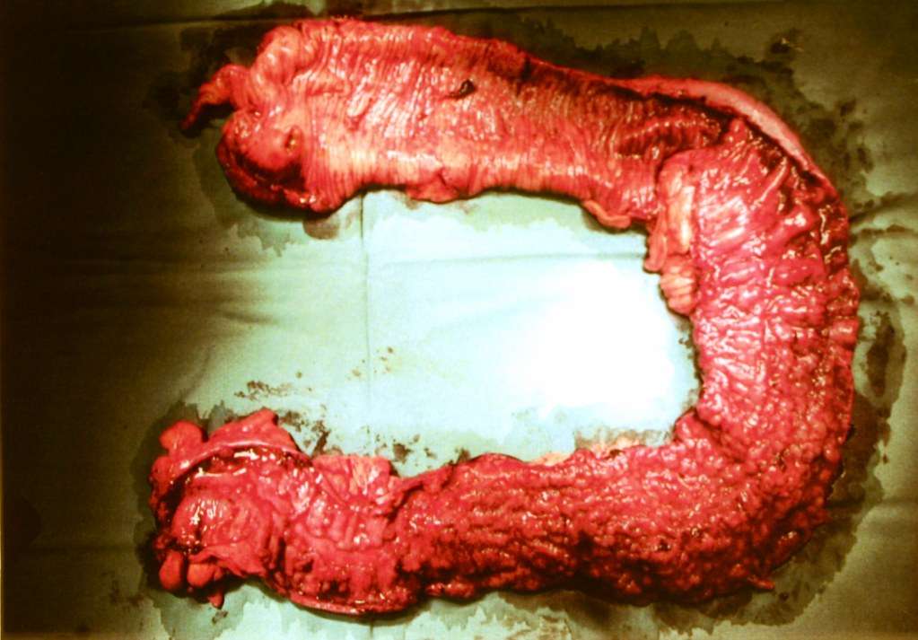diseased large intestine