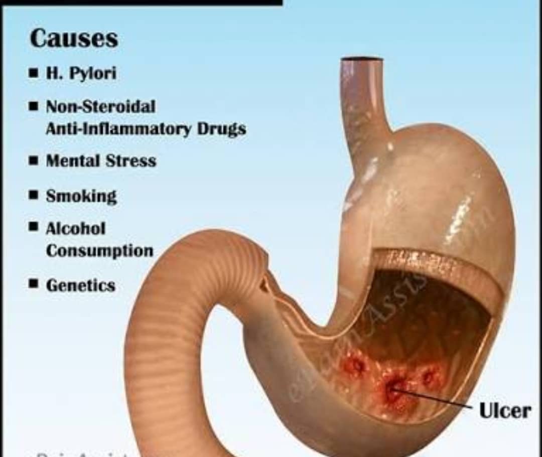 Diseases and patient care: What is peptic ulcer disaese and what are ...