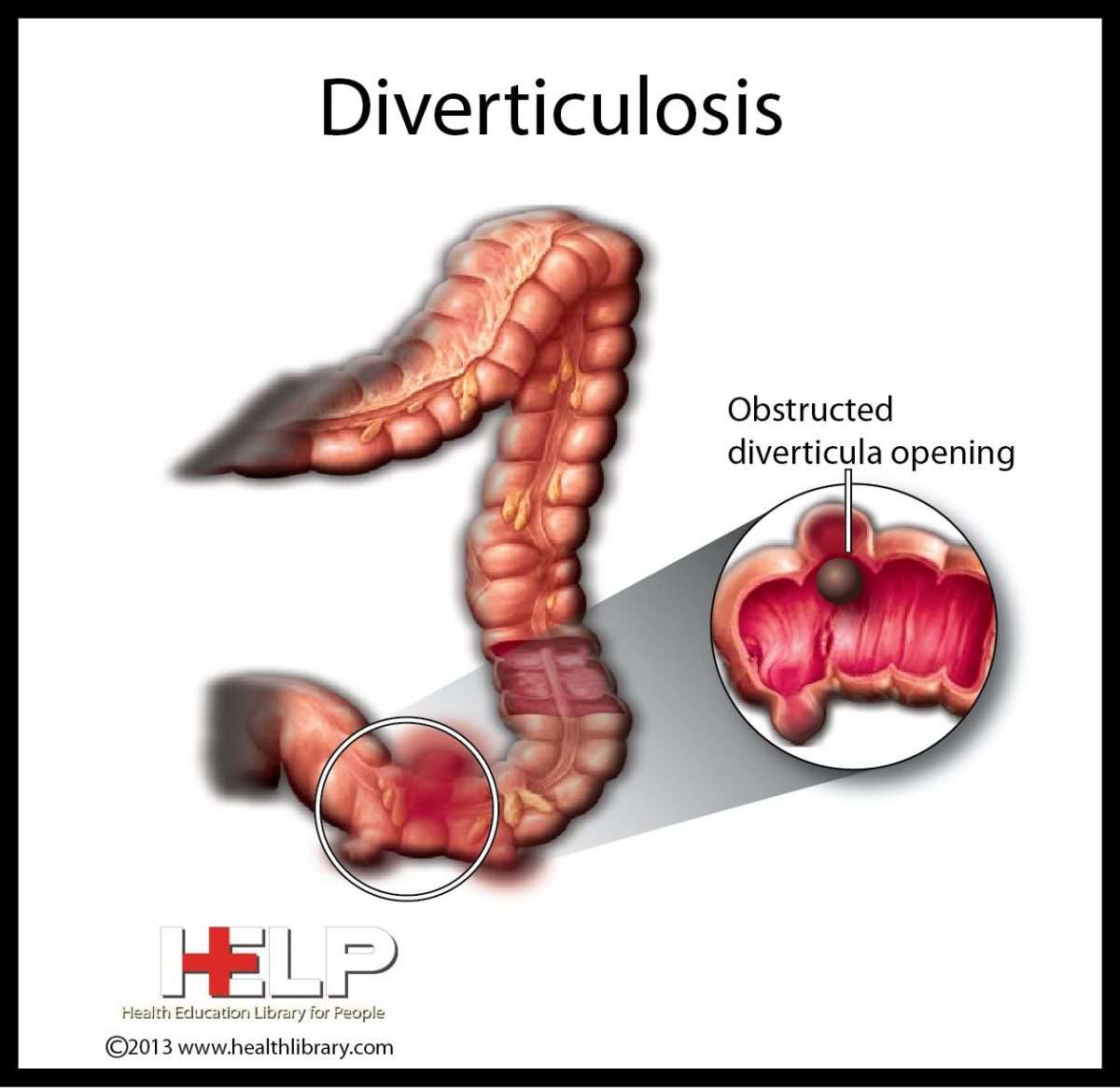 Diverticulosis and Diverticulitis as related to Ulcerative Colitis ...