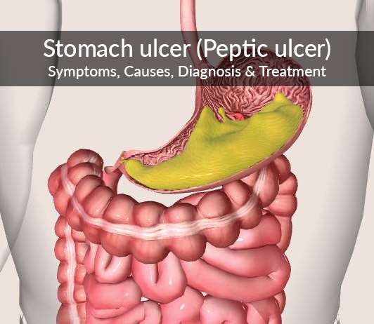 Do Stomach Ulcers Cause Gas