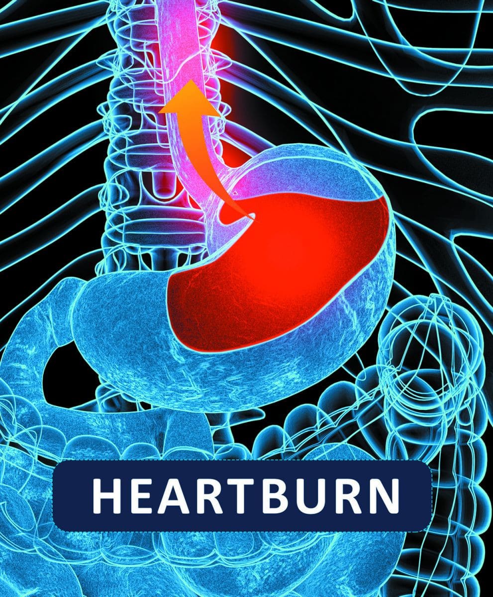 Does heartburn feel like a heart attack?