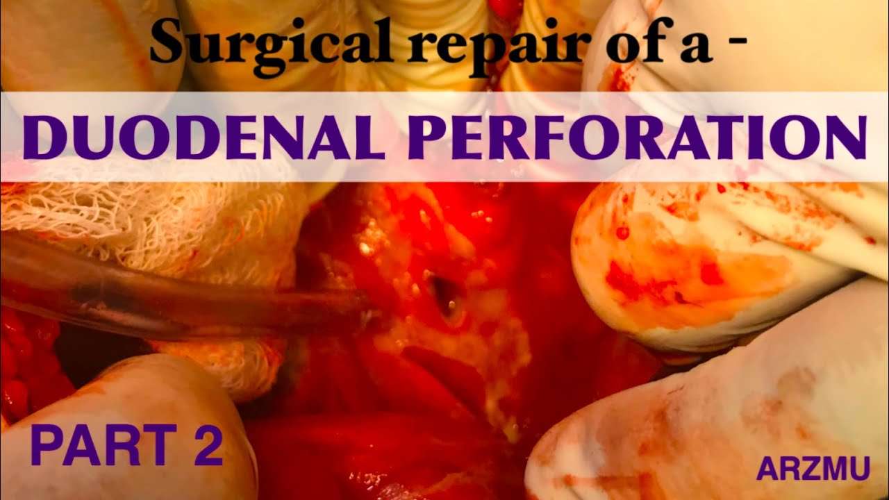 Duodenal Perforation