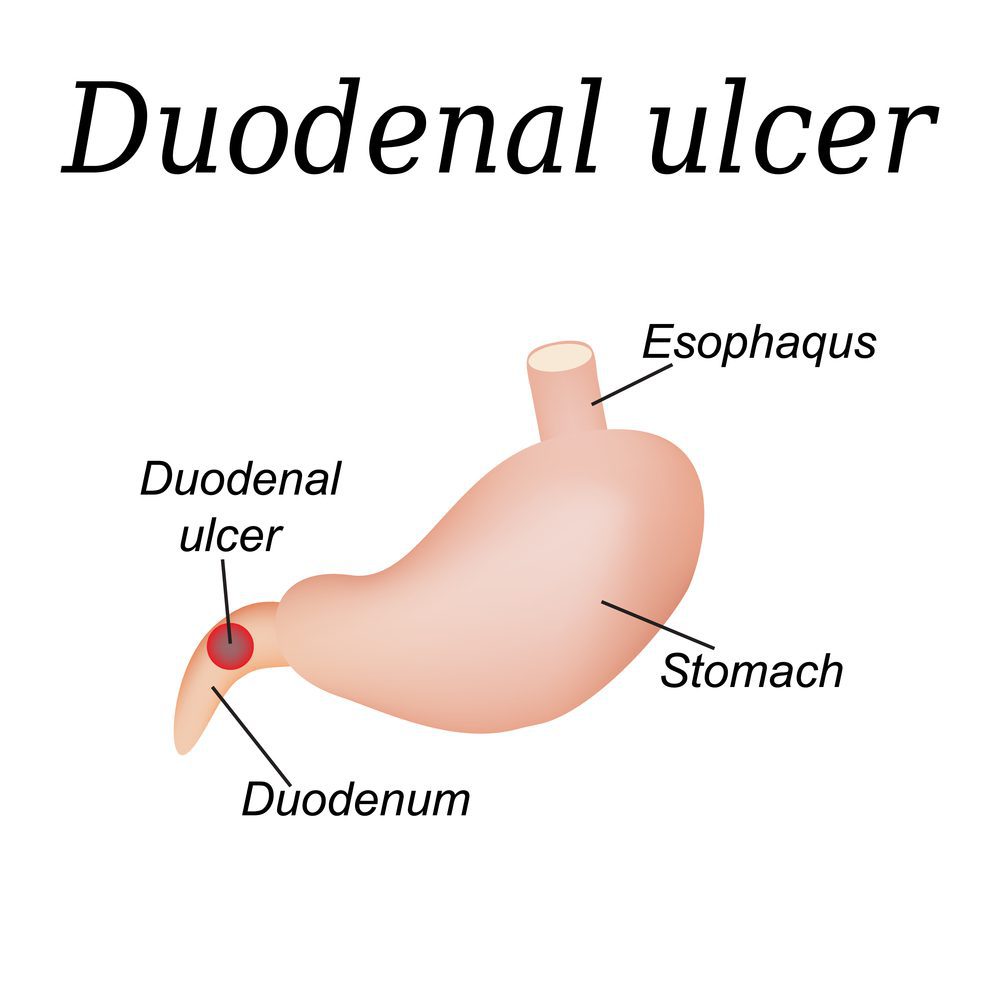 Duodenal Ulcer : Overview, Causes, Symptoms, Treatment