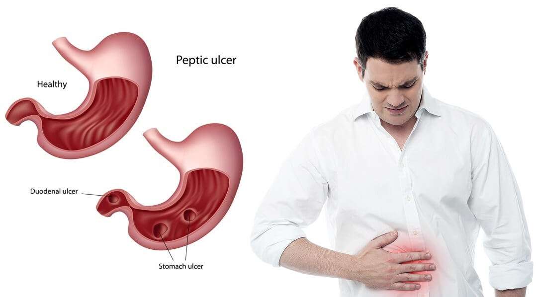 EARLY SYMPTOMS OF STOMACH ULCER TO WATCH OUT FOR
