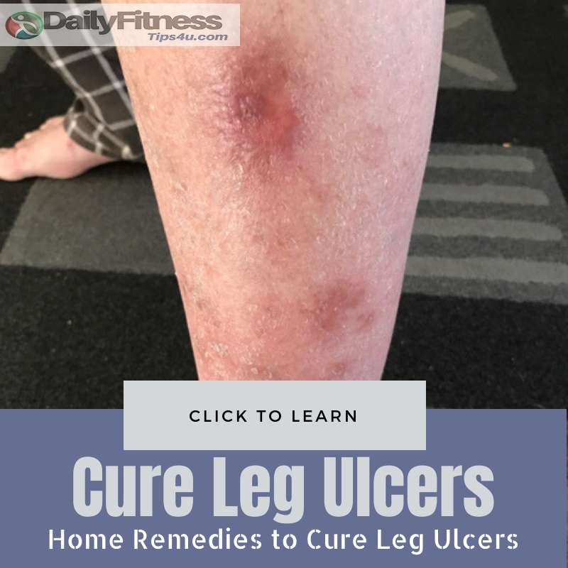 Effective Home Remedies to Cure Leg Ulcers