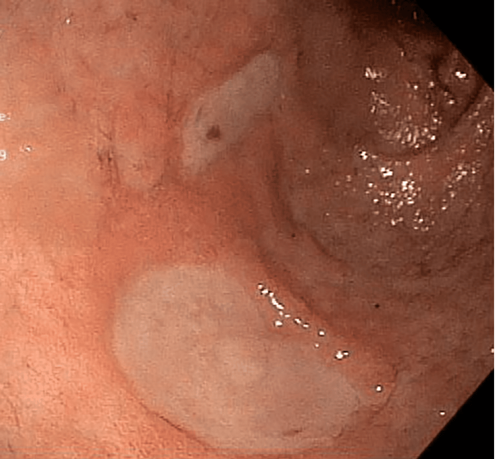 Endoscopic approach to gastric remnant outlet obstruction after gastric ...