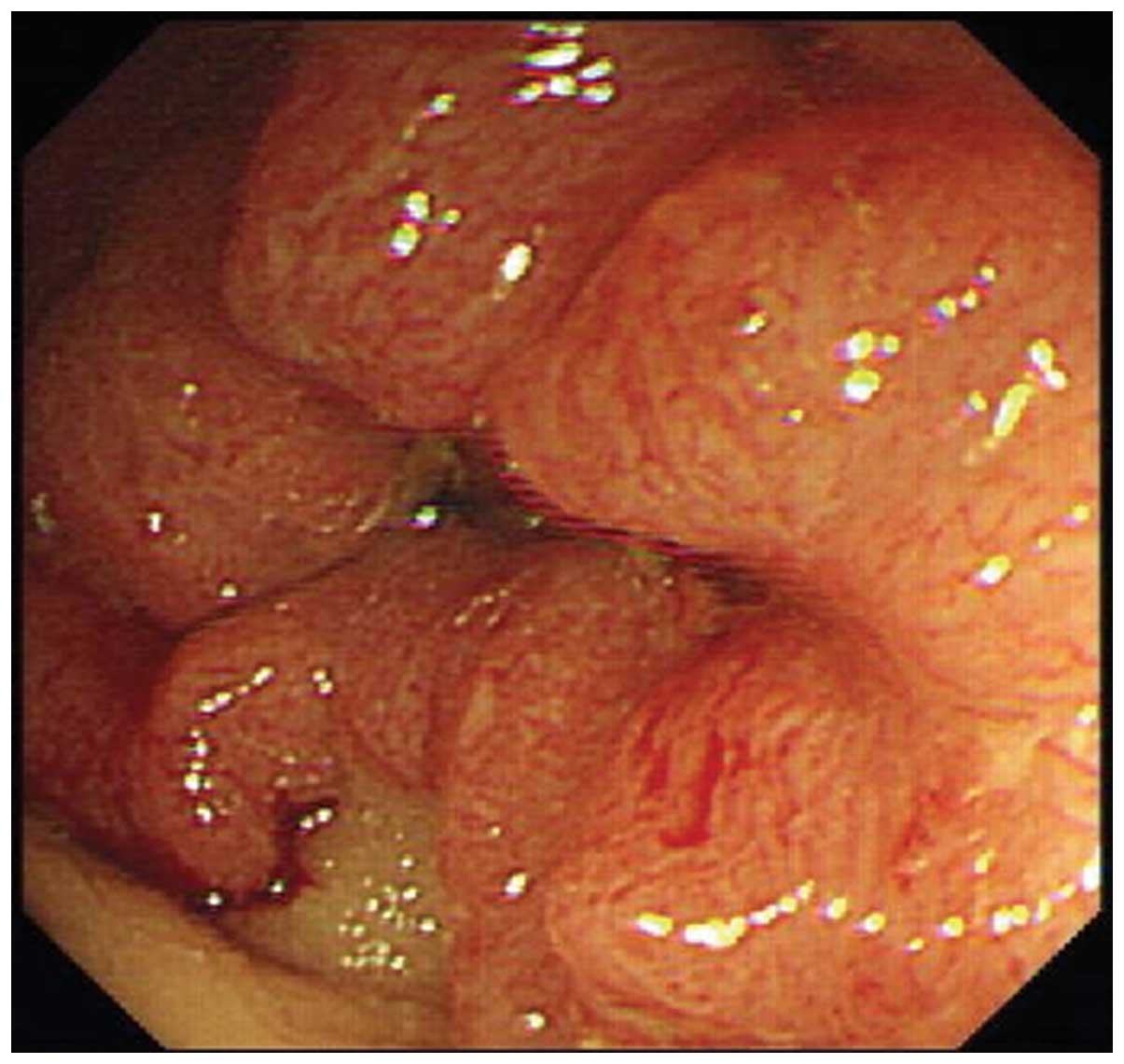 Endoscopic characteristics and causes of misdiagnosis of intestinal ...