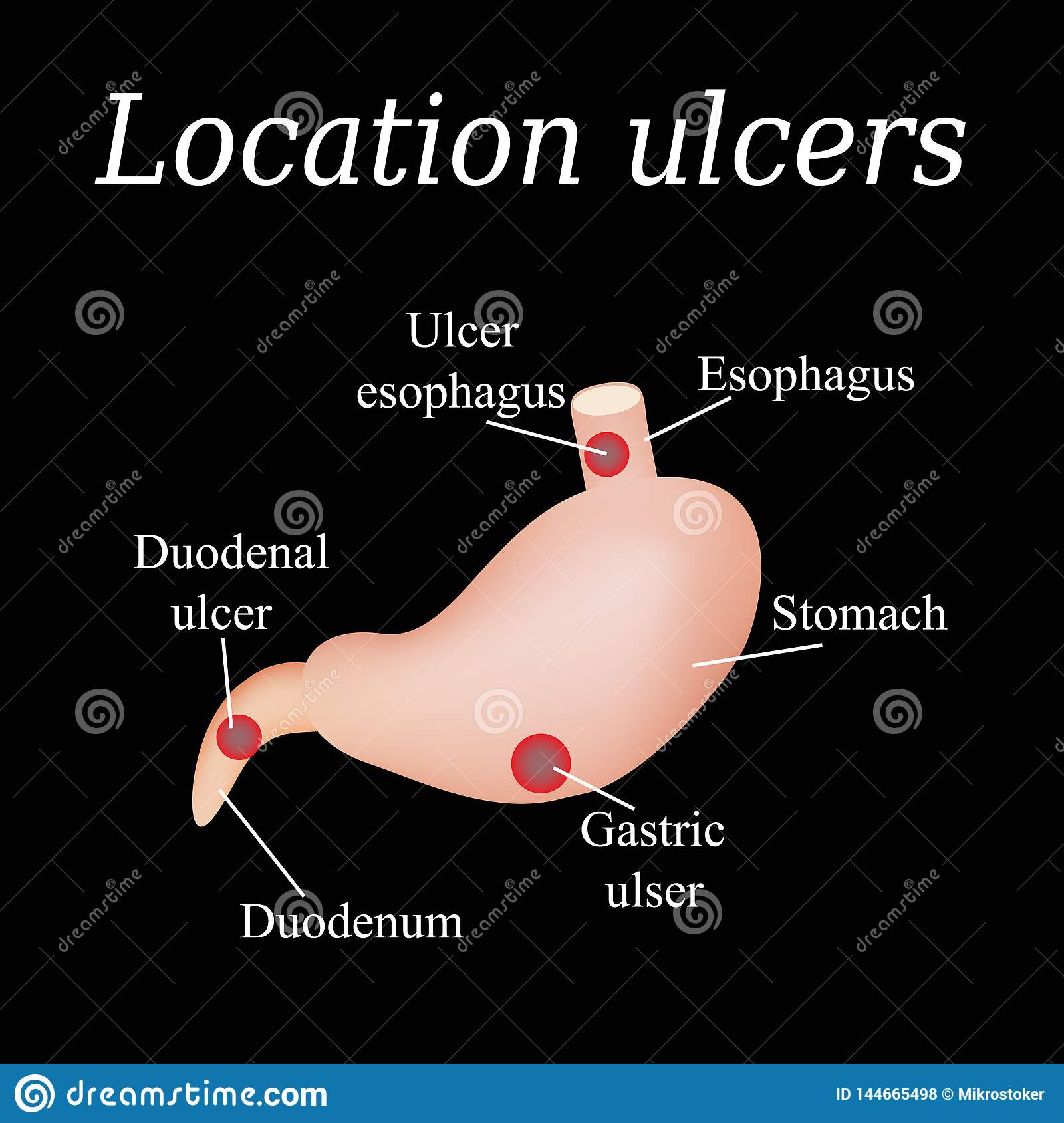 Esophagus Ulcer Affected. Ulcer of Esophagus. Stomach Ulcer Affected ...