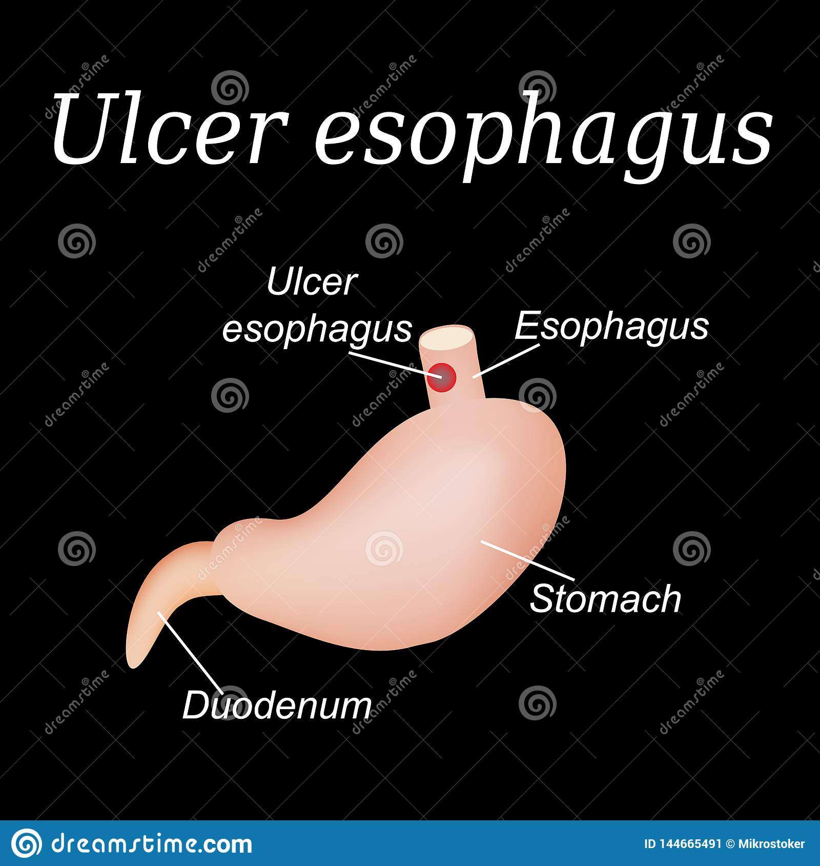 Esophagus Ulcer Affected. Ulcer Of Esophagus. Vector ...