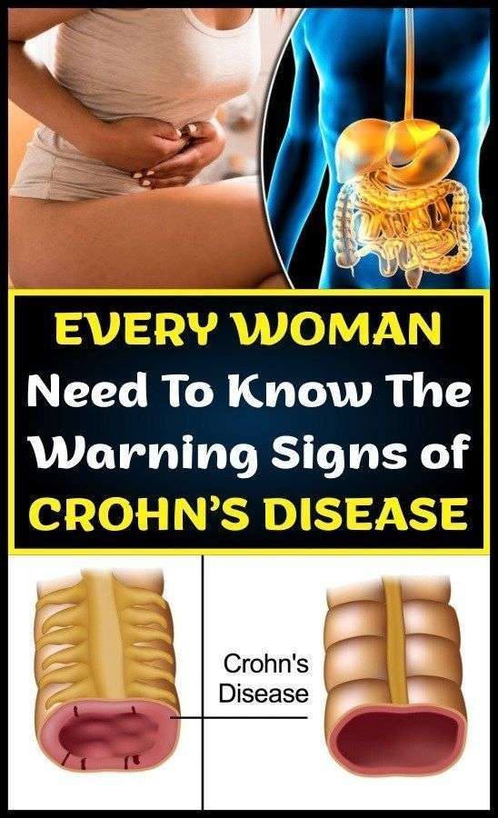 EVERY WOMAN NEED TO KNOW THE WARNING SIGNS OF CROHNS DISEASE