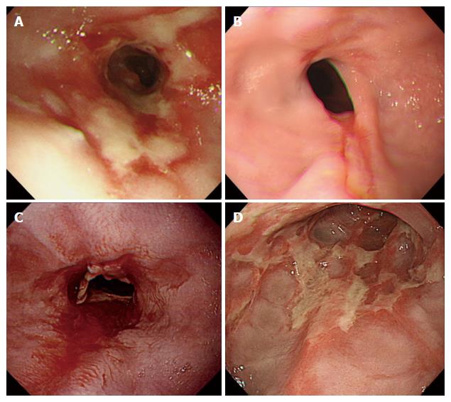 Factors associated with complicated erosive esophagitis: A Japanese ...