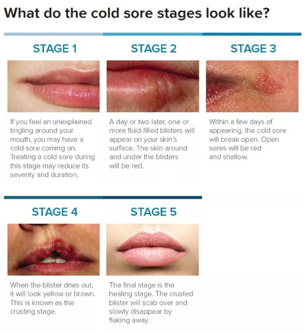 Fever Blister on Lip &  Cold Sores