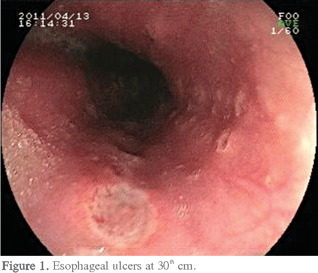Figure 1 from Esophageal ulcers : A possible adverse effect of ...