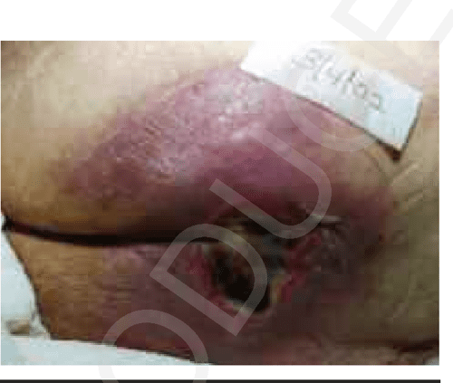 Figure 1 from Kennedy terminal ulcer: the " ah