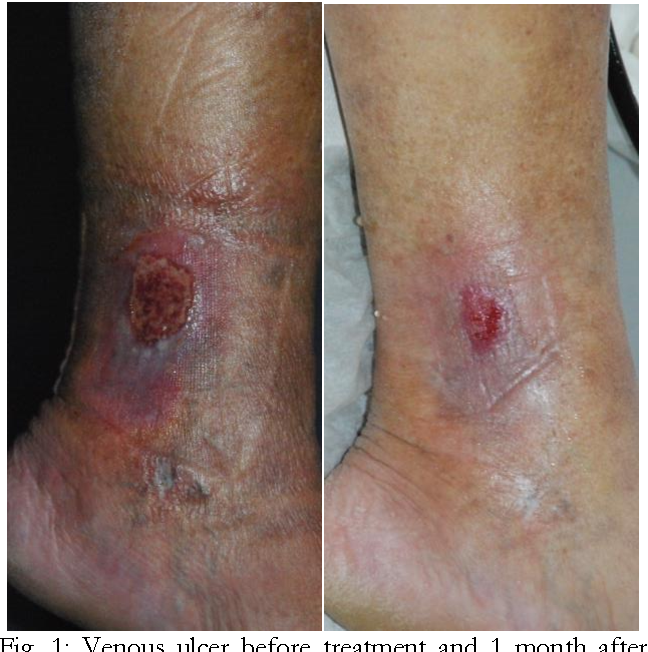 Figure 1 from Treatment of Venous Ulcer of the Lower Leg by Endovenous ...