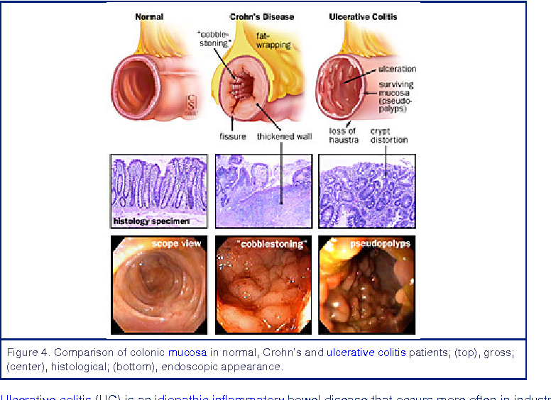 Figure 4 from [Ulcerative colitis. Introduction ...