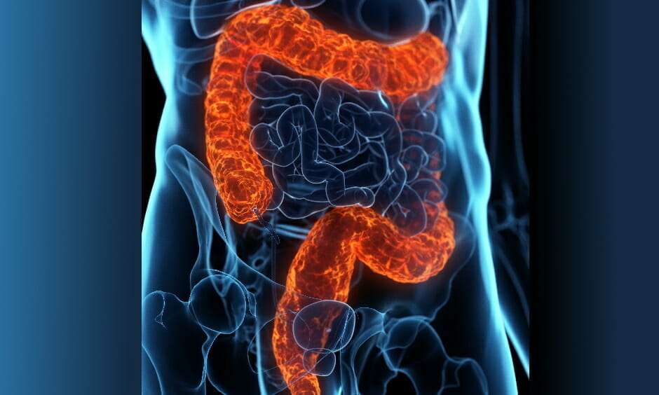 Filgotinib Associated With Clinical Remission in Ulcerative Colitis Study