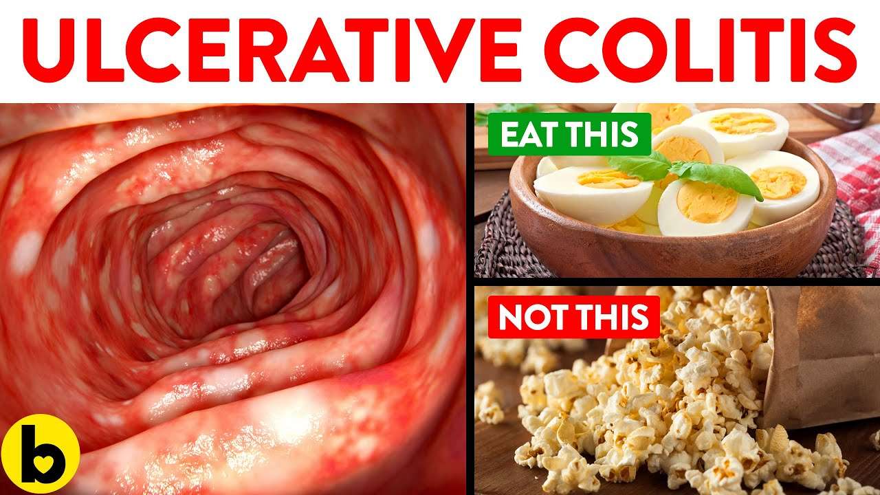 Foods You Should And Should Not Eat With Ulcerative ...