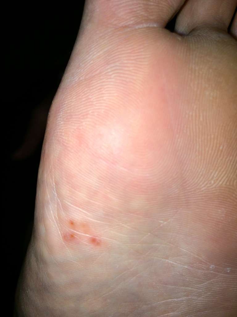 Foot ulcer.