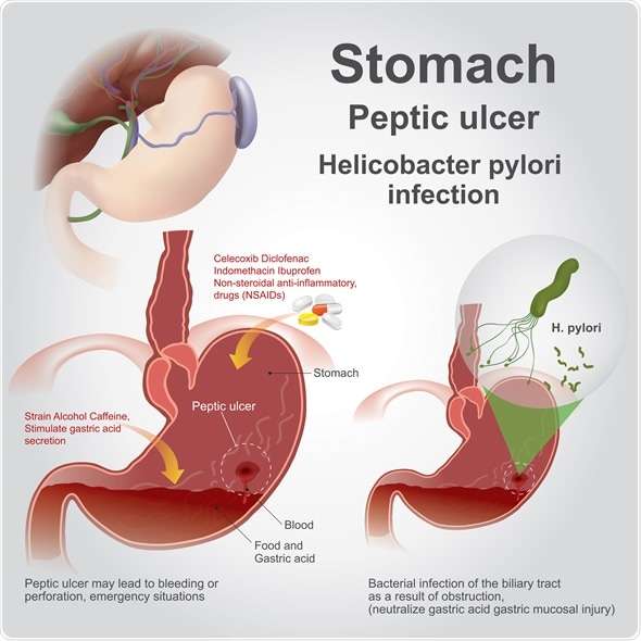 Forever products for Peptic Ulcer (Stomach Ulcer)