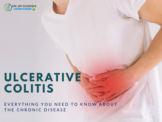 Gastro Surgeon Surat: Ulcerative Colitis: Learn more about the Chronic ...