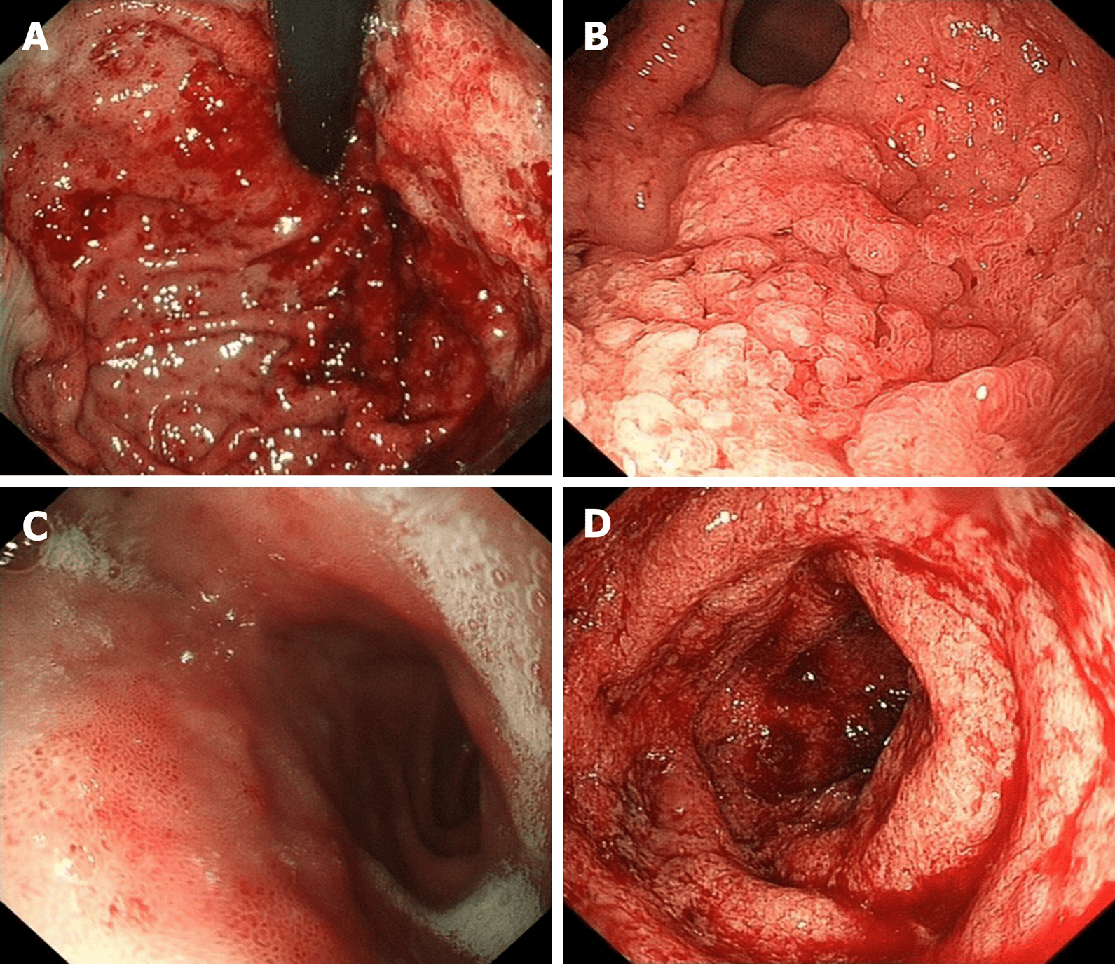 Gastroduodenitis associated with ulcerative colitis: A case report